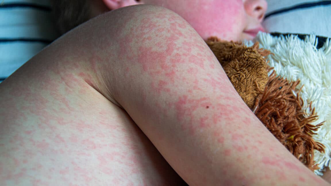 Analysis of Texas measles outbreak shows just how dangerous virus is