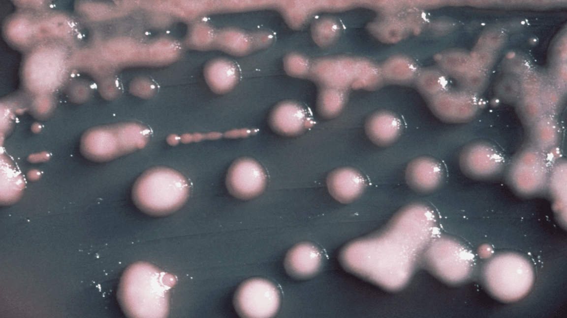 A woman got a UTI. Two years later, the bacteria had evolved, invaded her brain.