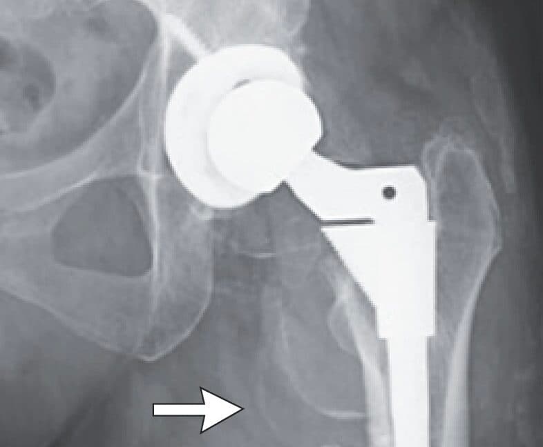 Woman's hip replacement disintegrates, causing severe metal poisoning